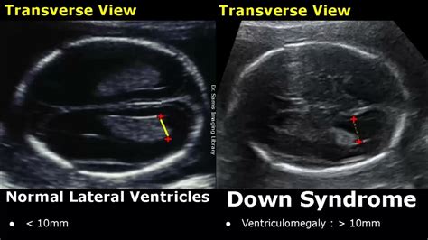 down syndrome tits|Fetal breasts in normal and Down syndrome fetuses